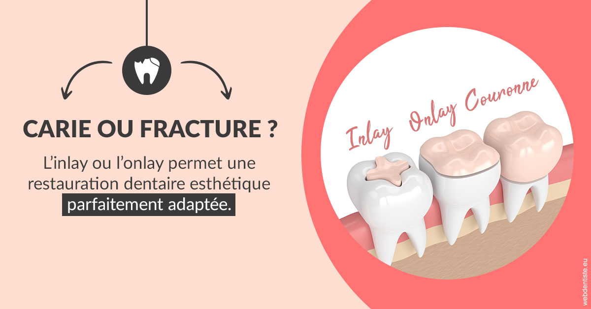 https://dr-bibas-alain.chirurgiens-dentistes.fr/T2 2023 - Carie ou fracture 2