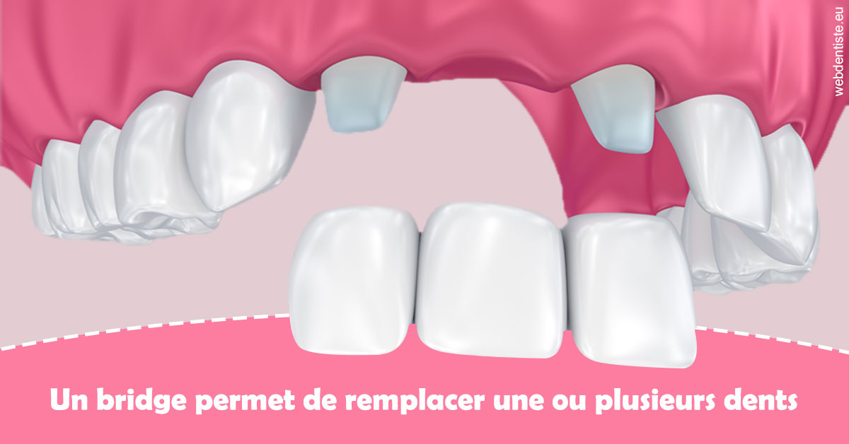 https://dr-bibas-alain.chirurgiens-dentistes.fr/Bridge remplacer dents 2