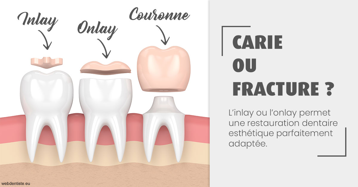 https://dr-bibas-alain.chirurgiens-dentistes.fr/T2 2023 - Carie ou fracture 1