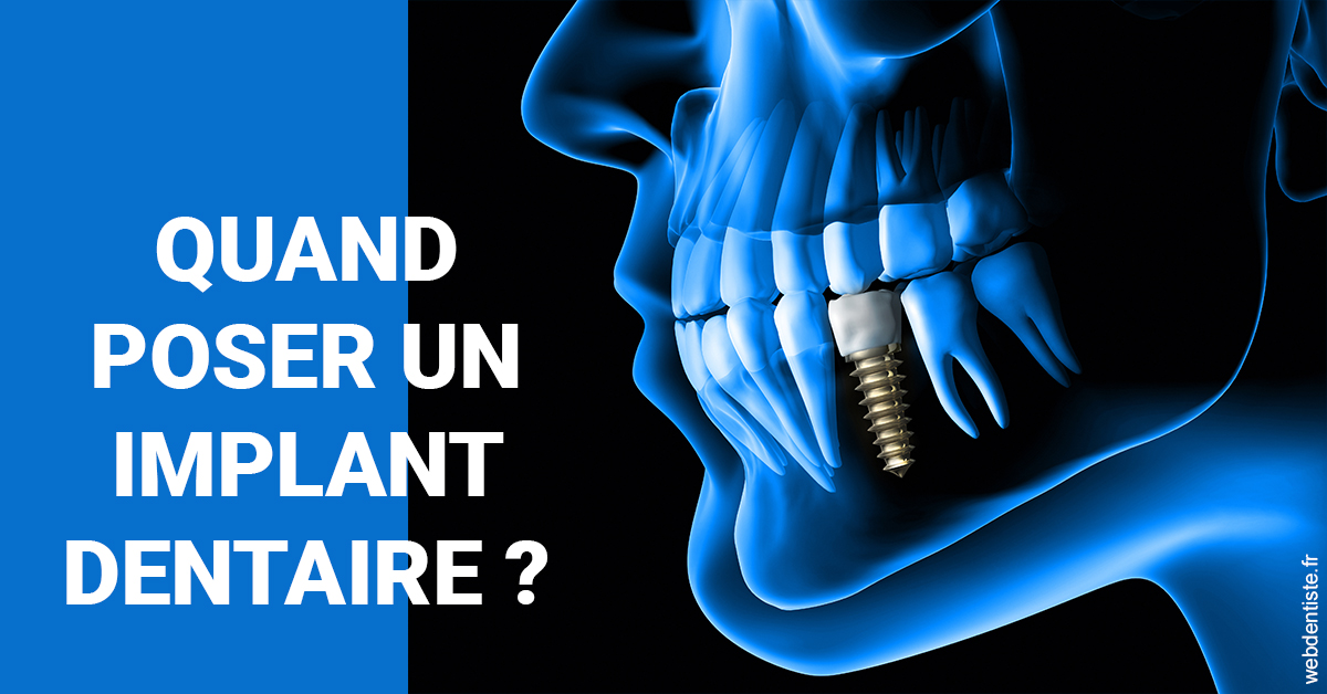 https://dr-bibas-alain.chirurgiens-dentistes.fr/Les implants 1