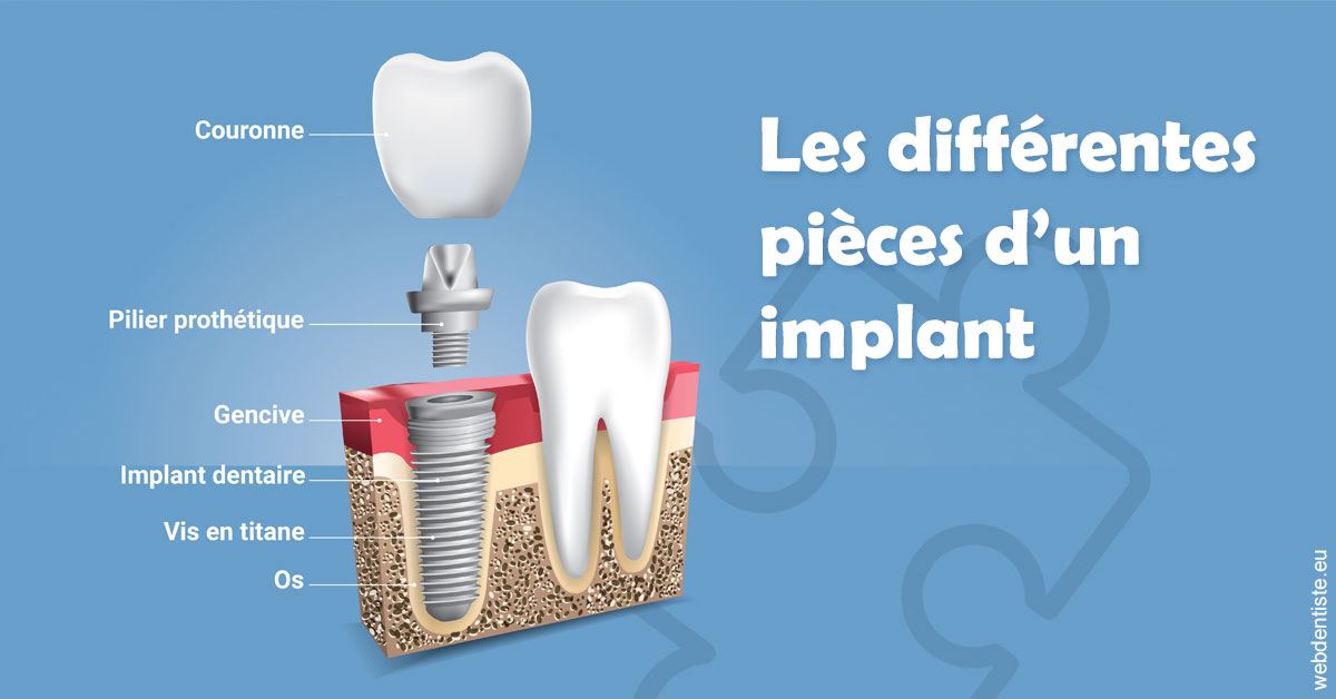 https://dr-bibas-alain.chirurgiens-dentistes.fr/Les différentes pièces d’un implant 1